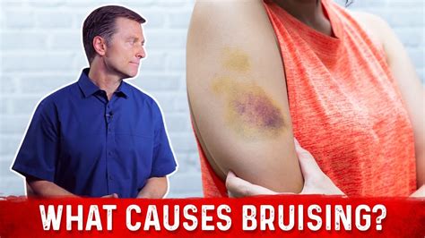 What Causes Bruising (Without Trauma) – Dr. Berg - YouTube