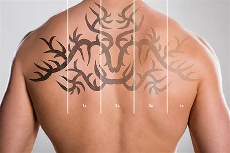 Laser Tattoo Removal | Atlanta, GA