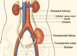 Explain Kidney Transplant Surgery Treatment - Assignment Point