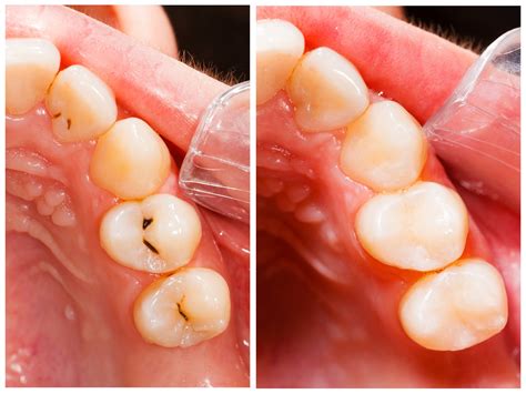 Benefits of Composite Resin Fillings - Smilepoint Dental