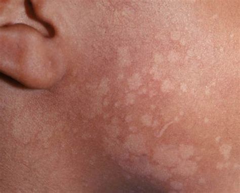 Tinea Versicolor - Causes, Signs, Symptoms, Treatment & Remedies