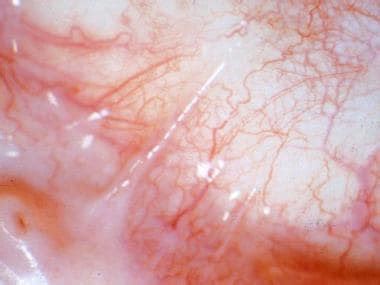 Cicatricial Skin Lesions