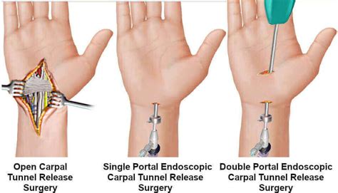 Pros & Cons of Endoscopic Surgery for Carpal Tunnel