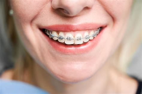 Ceramic Braces | Om Sai Dental & Implant Center