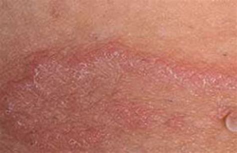 What Is Jock Itch, and What to Do about that Red, Itchy Penile Skin ...