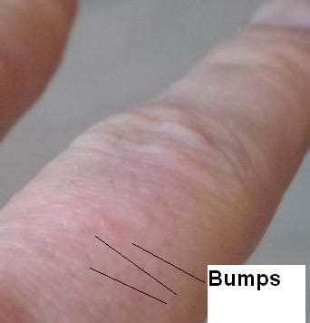 finger-bumps-itchy-hand-eczema