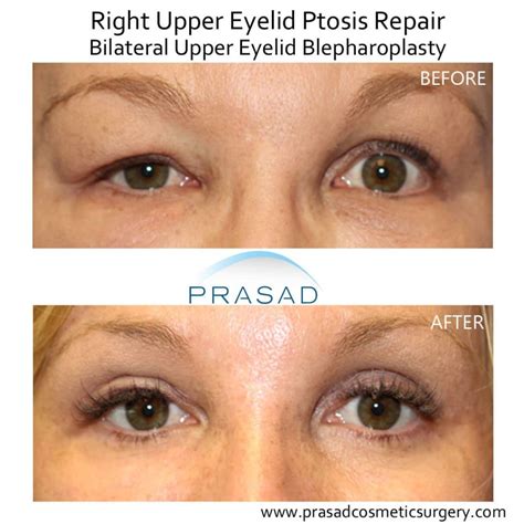 Upper Blepharoplasty Gone Wrong