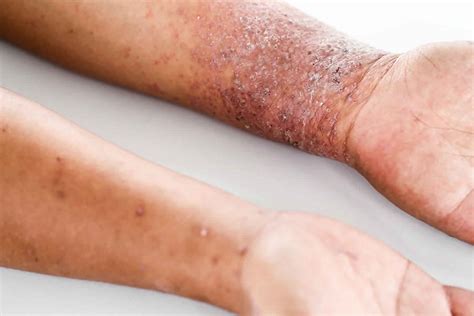 Dermatitis Rash On Hands