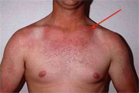 Complications of carcinoid syndrome - MEDizzy