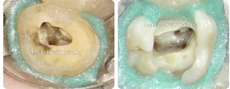 Molars anatomy pt1: upper second molar - Style Italiano Endodontics