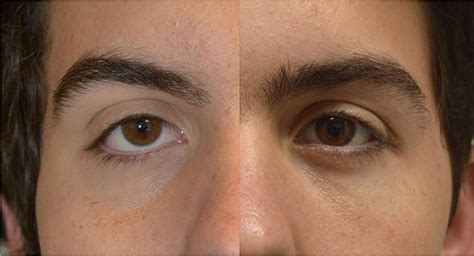 Beverly Hills Eyelid Retraction | Graves Disease Treatment