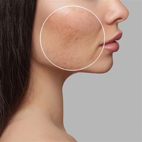 ACNE SCARS - Types of Acne Scars And Acne Scars Treatment - Ecosh