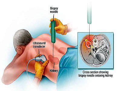 Renal Biopsy | Kidney biopsy, Chronic kidney disease, Kidney