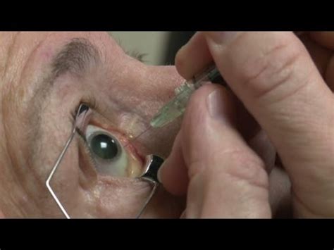 Eyeball injections equal eye-popping profits - YouTube