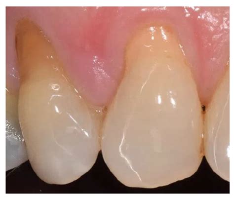 Applied Sciences | Free Full-Text | A New Combined Protocol to Treat the Dentin Hypersensitivity ...