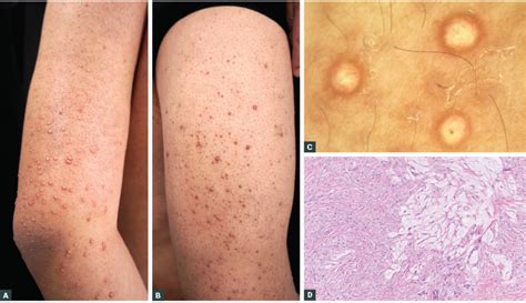 RACGP - Eruptive xanthoma associated with hypertriglyeridaemia and diabetes