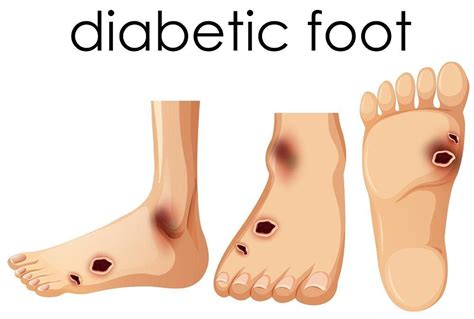 How to Prevent Diabetes-Related Foot Amputation : The Foot Care Group ...