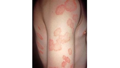 10 common rashes on kids (with photos) - Today's Parent