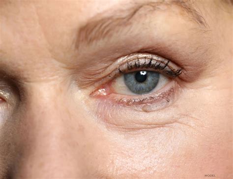 Eyelid Lumps and Bumps Removal | Chicago Oculofacial