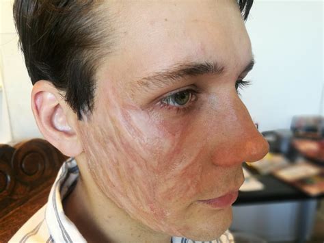 Burn Scar | MAD | Makeup Arts & Designs