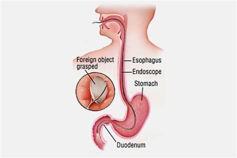 Foreign Body Removal - Gastrocare Hospital