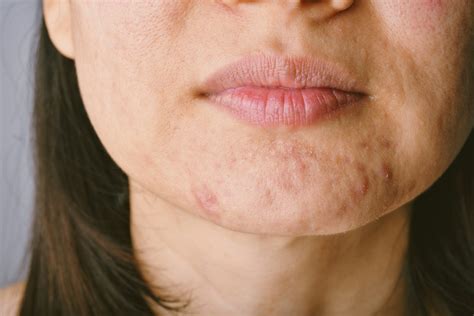 6 Ways To Manage Acne During Menopause - Women's Health and Menopause ...