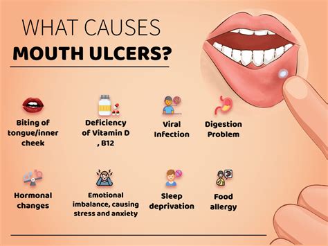 21 Best Home Remedies And Gel For Mouth Ulcers » Lifelonghealth.in