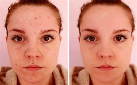 Skin Blemishes & Disorders | Hill Street Clinic