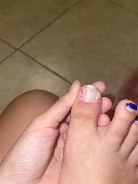 Granulation tissue 1 week after ingrown removal? : r/Ingrown_Toenails