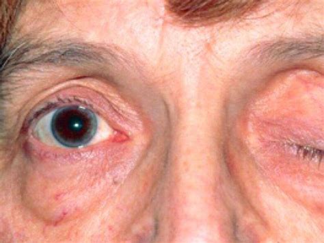 Myasthenia Gravis: What Is Myasthenia Gravis?