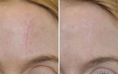 Scar Removal Before & After Photos Annapolis MD