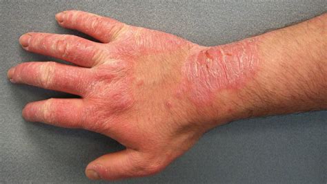Hand Rashes: Causes, Tips, Prevention, & Treatment