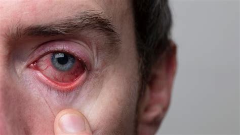 Infectious Eye Disease: Expert Explains Trachoma And How It Can Lead To Vision Loss | OnlyMyHealth