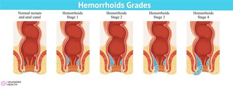 Hemorrhoids, Causes, Symptoms And Treatment!