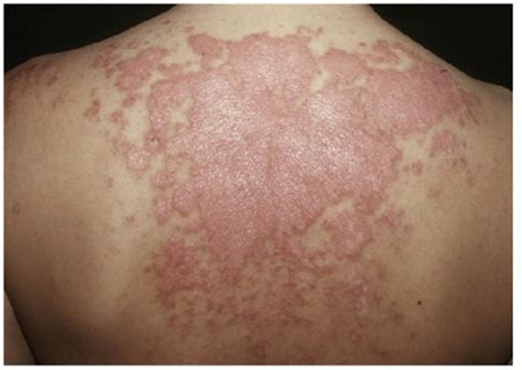 Cutaneous lupus erythematosus: An overview | MDedge Dermatology