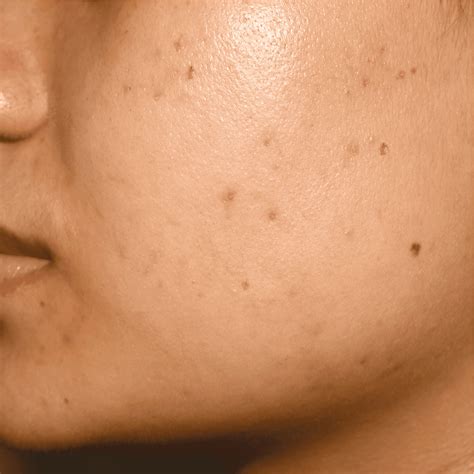 Post Inflammatory Hyperpigmentation Treatment - Ensoul Medical Clinic