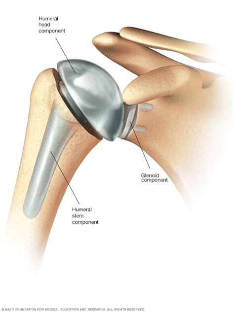 Shoulder replacement surgery - Mayo Clinic