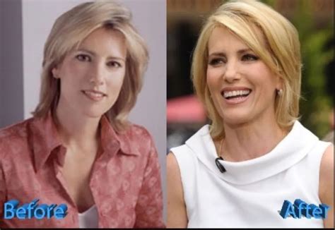 Did Laura Ingraham Get Plastic Surgery? TV Host Before And After Picture!