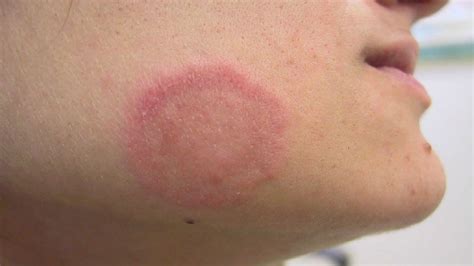 Ringworm, tinea, causes, signs, symptoms, diagnosis & treatment