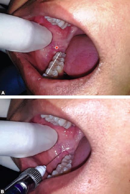 Long Buccal Nerve Block