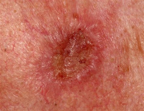 Squamous Cell Carcinoma Skin Cancer Questions Answered » Scary Symptoms