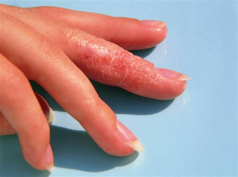 Eczema Bumps On Hands - vrogue.co