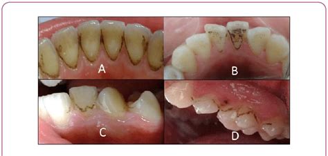 Black Stains On Teeth Causes - slide share