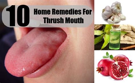10 Home Remedies For Thrush Mouth | Home remedies for thrush, Home ...