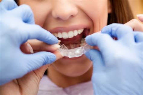 Comparing the Invisalign Process With Traditional Braces - Palm Beach ...