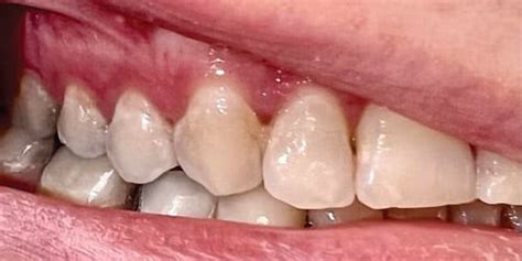 Managing Enamel Demineralization - Dimensions of Dental Hygiene