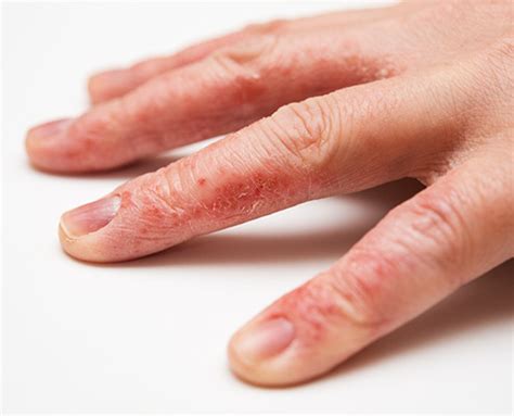 Eczema On Hands Types