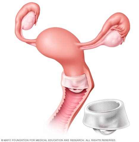 Cervical cap placement - Mayo Clinic