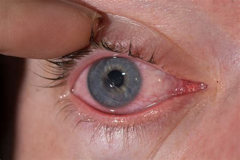 Corneal Abrasion | Eye Patient