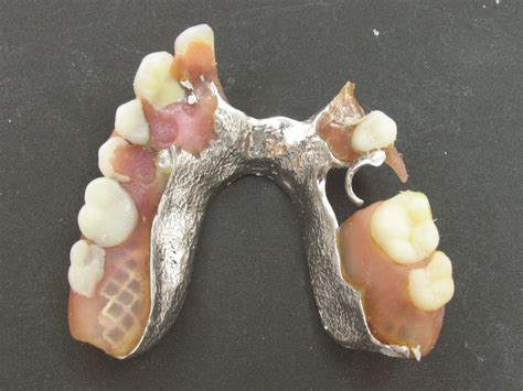 horseshoe partial denture design - vansvangoghline